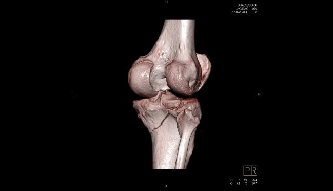 МРТ коленного сустава - что показывает? - фото 5