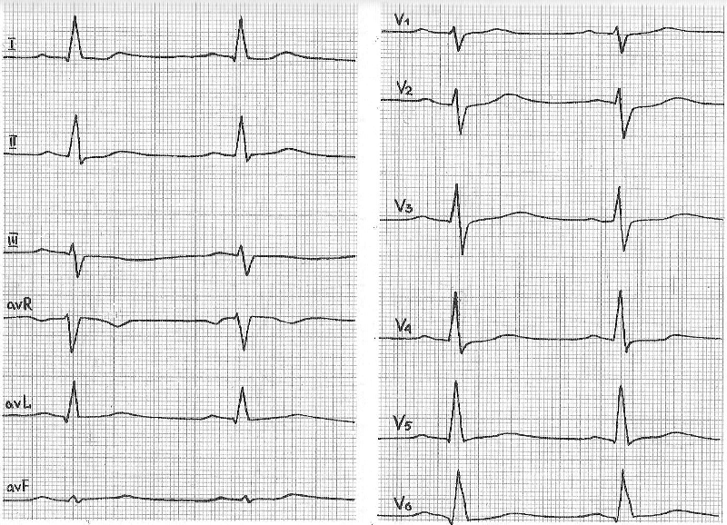Кардиограмма сердца и синусовый ритм: расшифровка, понятие - фото3
