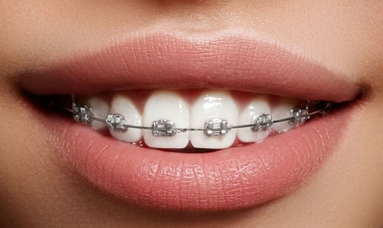 Брекети чи пластинка? Що краще викорситовувати для вирівнювання зубів?