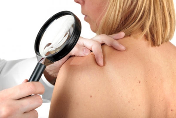 Подведены итоги недели диагностики онкозаболеваний кожи в регионе 