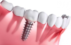 Имплантация - эффективный способ восстановления отсутствия зубов